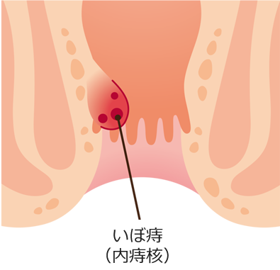 いぼ痔(内痔核)