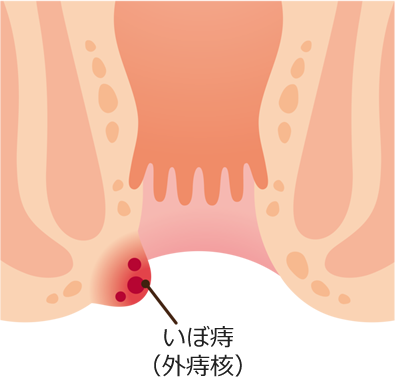 いぼ痔(外痔核)