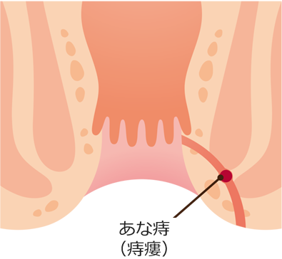 あな痔(痔瘻)