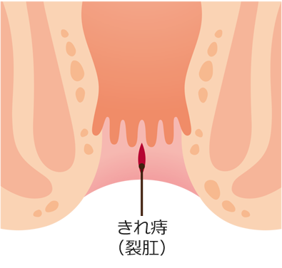 きれ痔(裂肛)