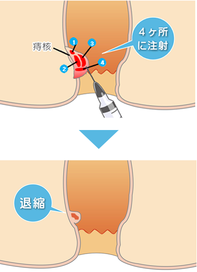 当院でのジオンによる硬化療法